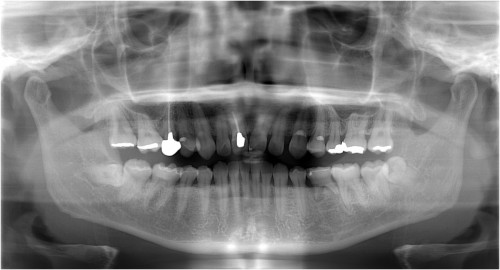 阿久井１ 術前　◎